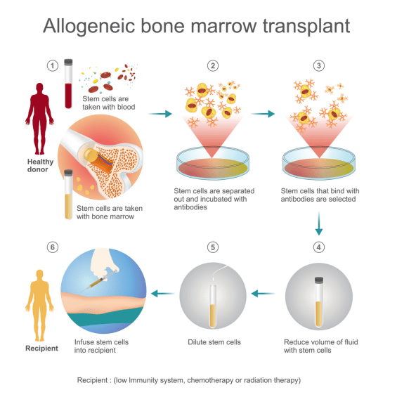Allogeneic Bone Marrow Transplant