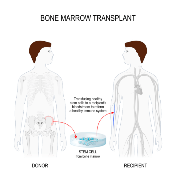 bone marrow transplant in bangalore