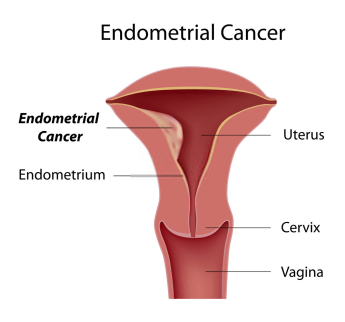 Endometrial Cancer