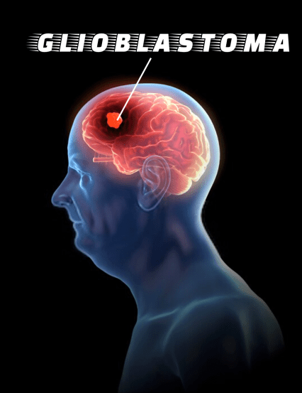 Glioblastoma -Multiforme | Brain Tumor