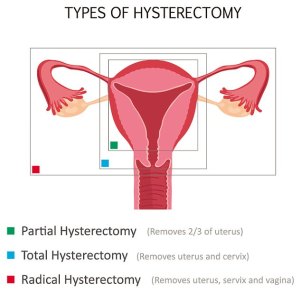 Hysterectomy