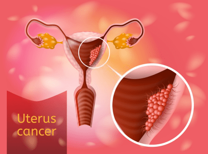 Uterine Cancer