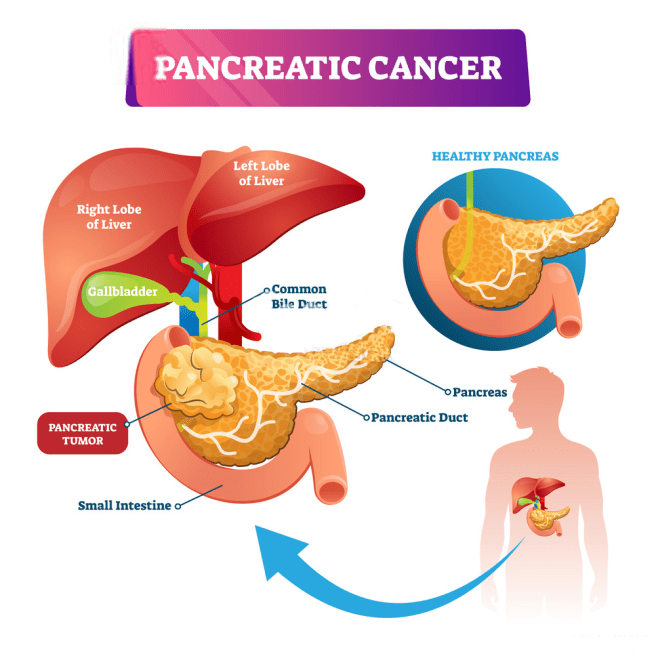 Pancreatic Cancer